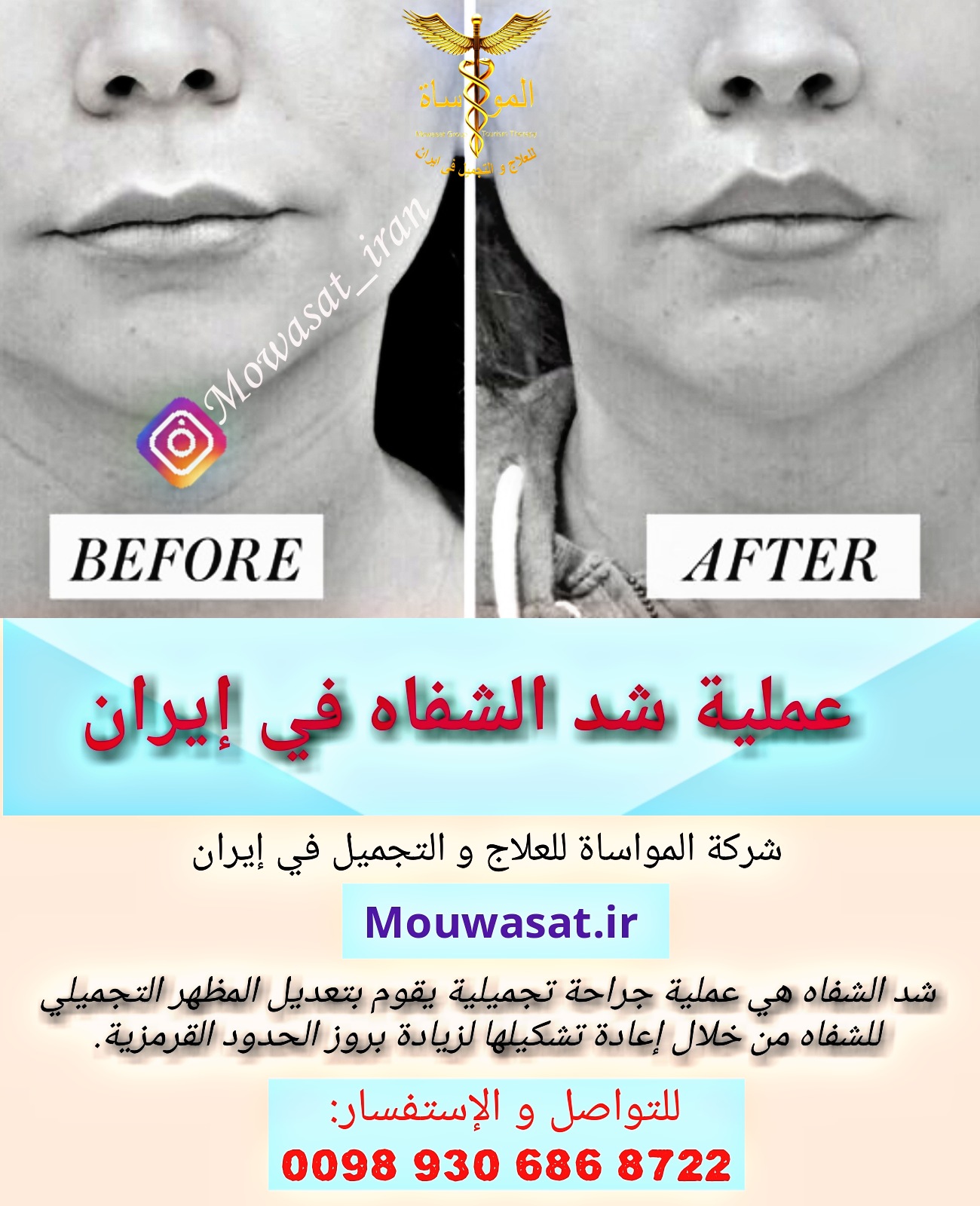 عملية شد الشفاه في إيران